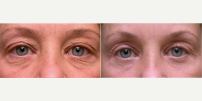 35-44 year old female treated with Eyelid Surgery - 38 year old female treated with lower blepharoplasty.
