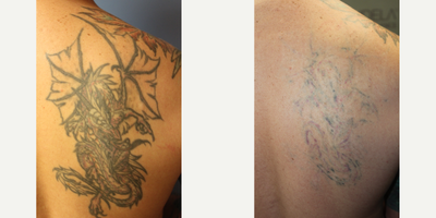 35-44 year old man treated with Tattoo Removal - This patient was seeking tattoo removal to lighten for a cover up. These pictures are before and after just 2 sessions.