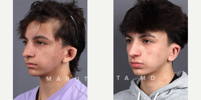 Man treated with Ear Surgery - Ear surgery, also known as otoplasty, can improve the shape, position or proportion of the ear. A defect in the ear structure that is present at birth or that becomes apparent with development can be corrected by otoplasty. This procedure can also treat misshapen ears caused by injury. Otoplasty creates a more natural shape while bringing balance and proportion to the ears and face. Correction of even minor deformities can have profound benets to appearance and self-esteem.