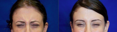 25-34 year old woman treated with Botox - Botox treatment to forehead, crows feet and eyebrow lift