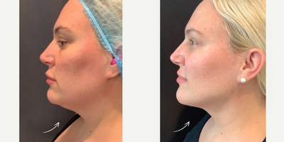 Woman treated with Smart Lipo - Smartlipo of the chin done by Dr. Marciano!!This amazing transformation shows the difference after just 2 week