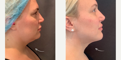 Woman treated with Smart Lipo - Smartlipo of the chin done by Dr. Marciano!!This amazing transformation shows the difference after just 2 week