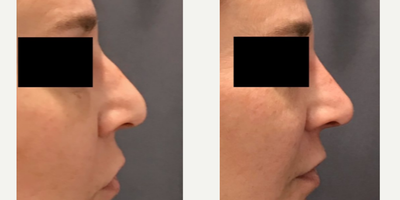 Woman treated with Nonsurgical Nose Job - Non-surgical rhinoplasty done by Dr. Marciano Achieve amazing results in just minutes!!