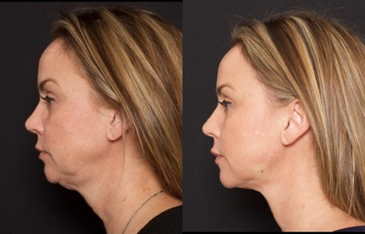 Woman treated with Thread Lift - Woman treated with Thread Lift