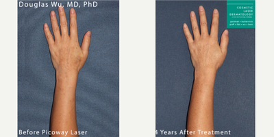 45-54 year old woman treated with Laser Treatment - PicoWay laser used to treat sun damage on the hand and arm by Dr. Wu.