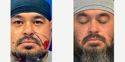 35-44 year old man treated with Facial Reconstructive Surgery - Facial Reconstruction Using a Nasolabial Flap Following Mohs Surgery for Facial Skin Cancer 3 Months Post-Op