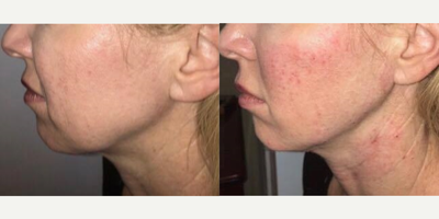 35-44 year old woman treated with Injectable Fillers - Injectable Fillers