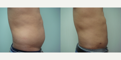 25-34 year old man treated with Liposuction - This patient underwent liposuction to the upper and lower abdomen, and flanks