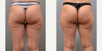 Cellulite reduction with Aveli - This lovely patient was bothered by cellulite in the back of her thighs and buttock region. She was interested in reducing the cellulite so I performed a cellulite reduction procedure using Aveli. At one month post-procedure, there is significant improvement. What is cellulite?Cellulite is the dimpled appearance of skin that is typically seen in the back of the thighs and buttock area.What causes cellulite?Thickened fibrous tissue that connects muscle fascia to the skin causes depressions on the surface of the skin. Who gets cellulite?Approximately 80-90% of adult women have cellulite to some extent.How is cellulite treated?Release of the fibrous tissue causing the dimpling is an effective way to reduce or improve the appearance of cellulite.What is Aveli?Aveli is a special device that safely and effectively releases the tethering causing cellulite, precisely where there is dimpling of skin.Who is a good candidate?Patients with mild to moderate cellulite without significant skin laxity or extra skin is an ideal candidate for cellulite reduction with Aveli.How long does it take?Depending on how many areas that need to be treated, it can take 1-2 hours with local anesthesia.What is the down time?Recovery is less than a week. Swelling and bruising is to be expected after the procedure. Compression garments should be worn to help with swelling and recovery.Photographs are posted with permission from patient.