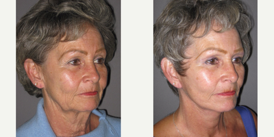 65-74 year old woman treated with Lifestyle Lift - This 67 year old healthy and active woman presented to our Center seeking rejuvenation of her lower face, jawline, and neck. She wanted to be sure that she kept a natural appearance and had initial concerns about looking stretched afterwards. After consultation and examination, we decided to proceed with a Lifestyle Lift. This procedure tightened both her jawline and neck in addition to reducing the neck bands under her chin. This procedure was performed comfortably and safely in our Center under local anesthesia with a small amount of oral sedation with valium.