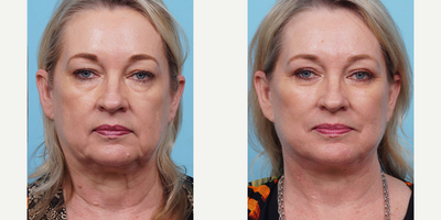 Woman treated with Facelift - This patient was bothered by her heavy upper eyelids, bags under her eyes and her neckline. Dr. Balikian preformed a upper and lower Blepharoplasty and Facelift 6 months ago. Dr. Balikian has managed to make the patient look like herself with a refreshed look!
