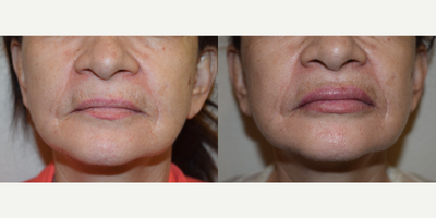 65-74 year old woman treated with Lip Augmentation - This 70 year of patient desired to restore some fullness to her upper and lower lips that lost volume with advancing age. She has used dermal fillers in the past but desired a more permanent option that would save her financial resources over time. We placed 4mm PermaLip Implants in both the upper and lower lip. This procedure is performed using local anesthesia and is an office procedure that takes approximately 30 minutes to complete.