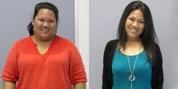 Gastric Bypass