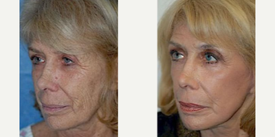 Woman treated with Facelift - Woman treated with CO2 Laser Resurfacing and mini Facelift
