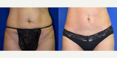 45-54 year old woman treated with Smart Lipo - This active patient came in with concerns of excess fat to abdominal area that did not respond with dieting and exercise. After visiting with Dr. Ho, patient elected to have the SmartLipo procedure to contour and eliminate fat to her areas of concern.