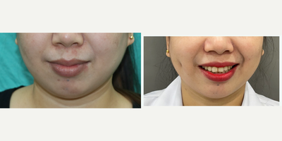 25-34 year old woman treated with Dimple Surgery (Dimpleplasty) - 26 year old beautiful lady underwent right dimpleplasty under local anaesthesia. Results shown at 1 week.