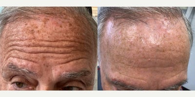 65-74 year old man treated with Fraxel Laser, Laser Peel, Skin Lightening - 71 year old treated with fraxel & ruby laser for sun damage brown spots