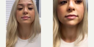 25-34 year old woman treated with Lip Fillers - When a patient comes to us wanting to perk up her already-beautiful lips, the key is to to make subtle enhancements. Over the next couple of weeks, her swelling will reside leaving her with an enviable pout!