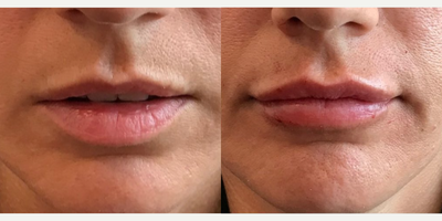 Woman treated with Dermal Fillers, Lip Fillers - Amazing natural lip filler transformation done by Dr. M.