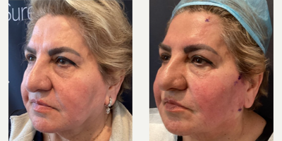 Woman treated with Skin Tightening - Tighten and lift with Attiva.Treat the face & body with this minimally invasive treatment.