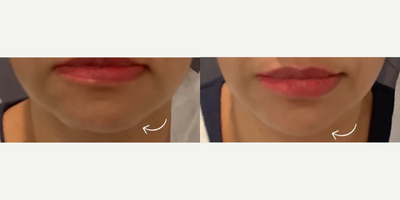 Woman treated with Skin Tightening - Amazing jaw line transformation done by Dr. Marciano!