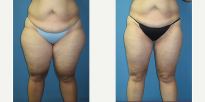 45-54 year old woman treated with Liposuction - Dr. Johnson performed Smartlipo on this patient to slim and smooth her thighs. The pictures are pre-op and 4 months post-op