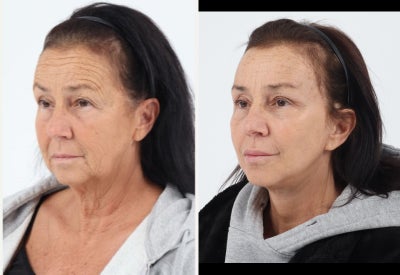 65-74 year old woman treated with Brow Lift, Eyelid Surgery, Facelift, Neck Lift, Facial Fat Transfer, Laser Resurfacing - Patient in her 60's 2month after a Facelift, Neck lift, Facial Fat Transfer, Temporal Brow Lift, Upper Eyelid Blepharoplasty and co2 laser.