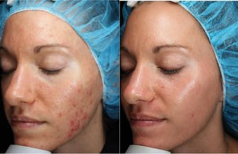 25-34 year old woman treated with Laser Treatment - Pearl Fractional is a new, fractional, single treatment laser designed to improve imperfections due to aging and sun damage. Pearl Fractional offers the best combination of safety, patient experience and recovery time. Take up to 10 years off in just one week!