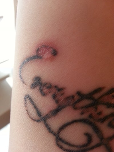Laser Tattoo Removal Quebec | laser tattoo removal 5 weeks ago will it finally heal Laser Tattoo Removal Quebec | laser tattoo removal 5 weeks ago will it finally heal