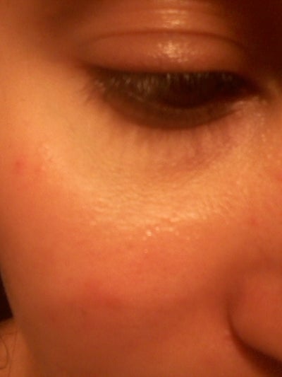 I used Retin A close to under my eye and now it looks like I used Retin A close to under my eye and now it looks like