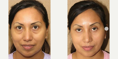 Woman treated with Eyelid Surgery - Woman treated with Eyelid Surgery
