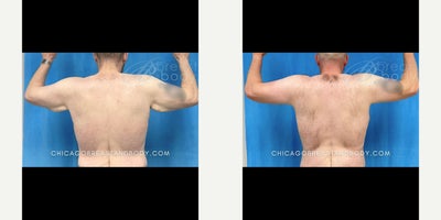 45-54 year old man treated with Arm Lift - Male patient underwent an arm lift brachioplasty procedure by Dr. Pey-Yi Kevin Lin at Chicago Breast & Body Aesthetics.
