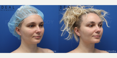 25-34 year old woman treated with Chin Liposuction, Laser Liposuction, Liposuction, Liposculpture, Tumescent Liposuction, Renuvi - We love her. Shes super cool, chill, confident, smart, easy to talk to, has great hair, and is SNATCHED! Were so happy for her after undergoing chin, neck, and jawline PRECISION SCULPT liposculpting.