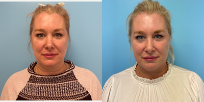 45-54 year old woman treated with ThermiTight - 51 year old female underwent ThermiTight surgery under general anesthesia