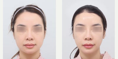 25-34 year old woman treated with MACS Lift + Forehead Reduction + Full-Face Fat Grafting - From Tired to Refreshed -> MACS Lift + Forehead Reduction + Full-Face Fat GraftingBefore the procedure, facial sagging was visible in the midface and jawline, the forehead appeared relatively long, and overall facial volume was uneven or depleted, creating a tired and aged appearance.After the procedure, the MACS Lift effectively repositioned sagging tissues for a firmer, more lifted midface and jawline, while forehead reduction improved facial proportions by shortening the upper face. Full-face fat grafting restored natural volume to hollow areas, enhancing contours and skin vitality, resulting in a more youthful, balanced, and harmonious facial appearance.