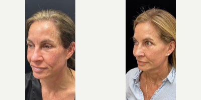 55 year old woman treated with Facial Fat Transfer - 55 year old woman treated with Facial Fat Transfer