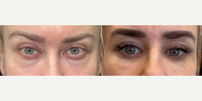 Woman treated with Eyelid Surgery - Woman treated with Eyelid Surgery