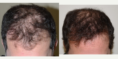 FUE Hair Transplant - FUE hair transplant on a middle aged male.