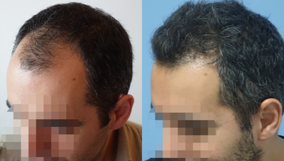 25-34 year old man treated with FUE Hair Transplant - 17 months post-operative