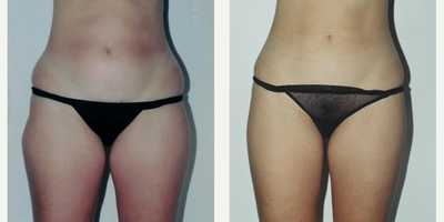 35-44 year old woman treated with Tumescent Liposuction - This patient had tumescent liposuction of the lower abdomen and thighs.