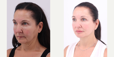 55-64 year old woman treated with Facelift, Neck Lift, Buccal Fat Removal - 60 year old patient 6 months after Facelift, Neck lift and Buccal Fat Removal