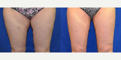 45-54 year old woman treated with Smart Lipo - Woman came in wanting to improve the look of her thigh area. After consulting with Dr. Ho, patient elected to have liposuction performed to inner and outer thighs.