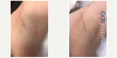25-34 year old woman treated with Laser Treatment - Laser Hair Removal.