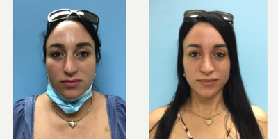 25-34 year old woman treated with Rhinoplasty - 25-34 year old woman treated with Rhinoplasty