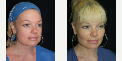 35-44 year old woman treated with Buccal Fat Removal - Patient with a bottom heavy face that underwent facial reshaping which included bilateral buccal lipectomies and facial fat grafting to the cheeks and lips.