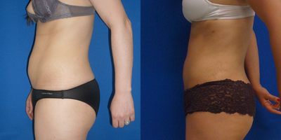 35-44 year old woman treated with Vaser Liposuction - VASER lipo under anesthesia. Before the advent of laser lipo, a lot of my cases involved ultrasound VASER.