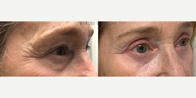 66 year old woman treated with CO2 Laser - 66 year old woman treated with CO2 Laser