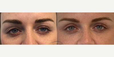 Woman treated with Ptosis Surgery - Dr. Maleki performed a revisional upper lid blepharoplasty to lower the right upper lid, raise the left upper lid and remove the extra folds to create a single, well-positioned and most importantly symmetric upper lid crease.