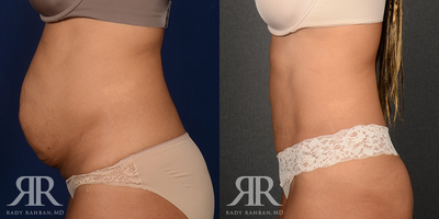 Woman treated with Diastasis Recti Repair - Woman treated with Diastasis Recti Repair