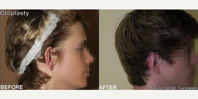 Man treated with Ear Surgery - Man treated with Ear Surgery